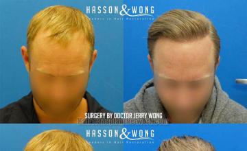 Before and after hair restoration procedure images