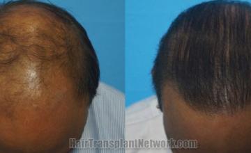 Top view - Before and after hair restoration results