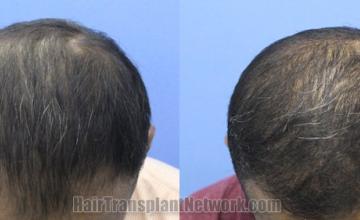 Top view - Before and after hair restoration results
