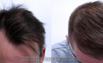 Top view - Before and after hair restoration results