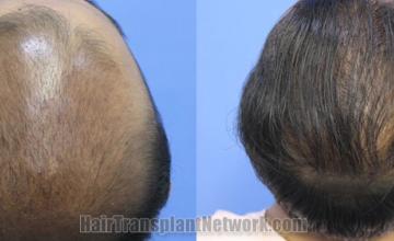 Top view - Before and after hair restoration results