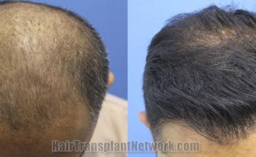 Top view - Before and after hair restoration results
