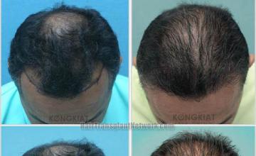 Hair restoration procedure before and after result photos