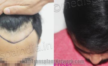 Top view - Before and after hair restoration results