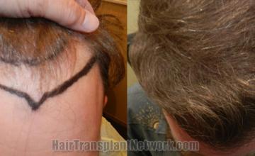 Top view - Before and after hair restoration results