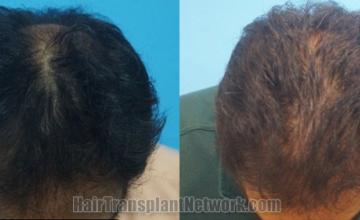 Top view - Before and after hair restoration results