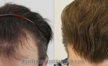 Top view - Before and after hair restoration results