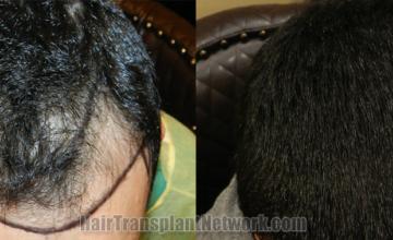 Top view - Before and after hair restoration results