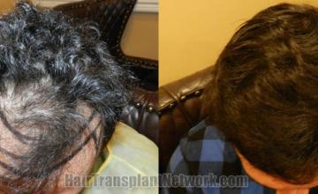 Top view - Before and after surgical hair replacement