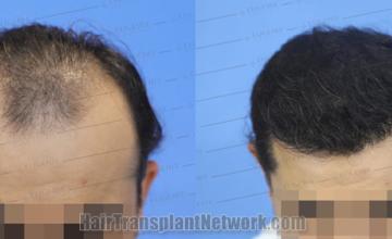 Top view - Before and after hair restoration results