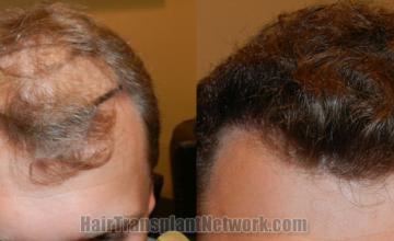Top view - Before and after hair restoration results