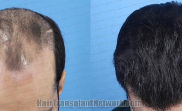  before and after result photographs