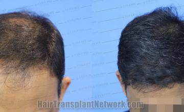 before and after result photographs