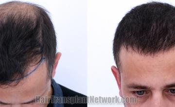 Top view - Before and after hair restoration results