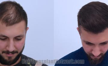 Top view - Before and after hair restoration results