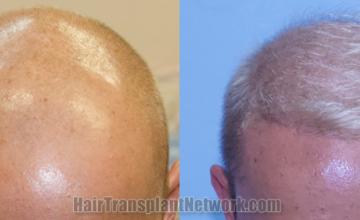 Top view - Before and after hair restoration results