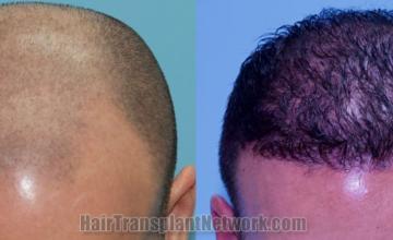 Top view - Before and after hair restoration results