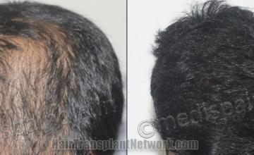 Top view - Before and after hair restoration results