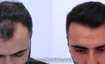 Top view - Before and after hair restoration results