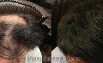 Top view - Before and after hair restoration results