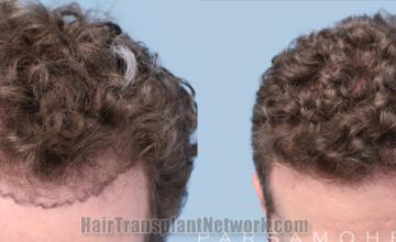 Top view - Before and after hair restoration results