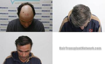 Hair transplantation surgery before and after images