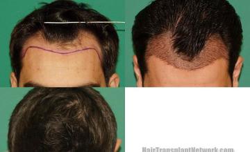 Before and after hair restoration procedure images