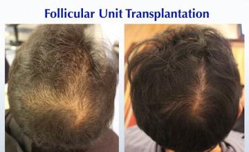 Hair transplantation surgery before and after images