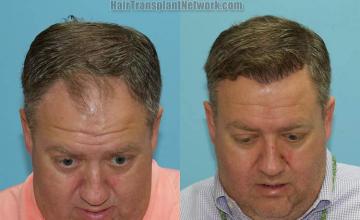 Before and after hair restoration procedure images