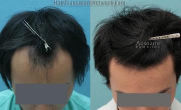 Hair transplantation surgery before and after images