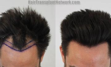 Before and after hair restoration procedure images