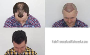 Hair transplantation surgery before and after images