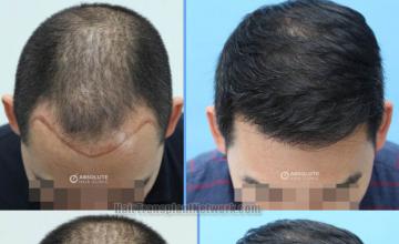 Hair transplantation surgery before and after images