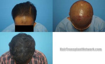 Before and after hair restoration procedure images