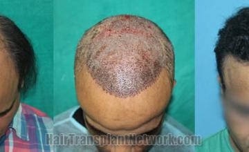 Hair transplantation surgery before and after images