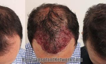 Hair transplantation surgery before and after images