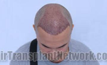 Hair transplantation surgery before and after images