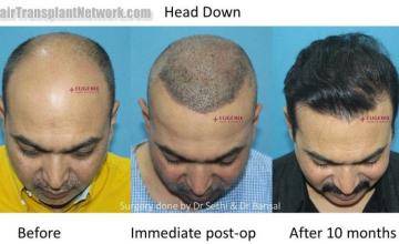 Hair transplantation surgery before and after images