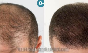  before and after result photographs