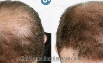  before and after result photographs