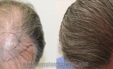 Top view - Before and after hair restoration results