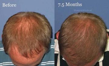 Top view before and after hair restoration results