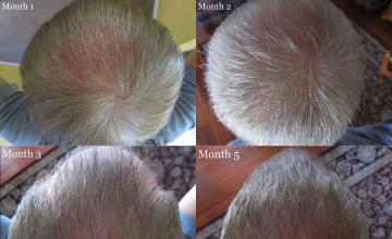 Hair transplantation surgery before and after photos