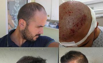 Hair transplantation surgery before and after images