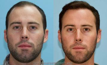 Front view - Before and after