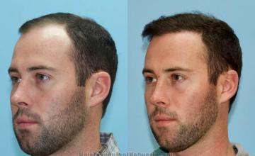  before and after photos