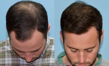 Before and after hair restoration procedure images
