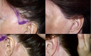 Left side view of woman's hair transplant before and after