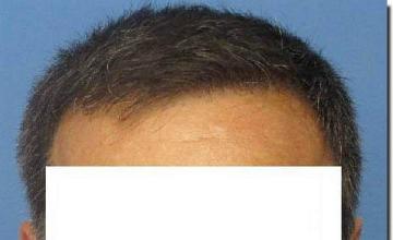 Hair restoration procedure results