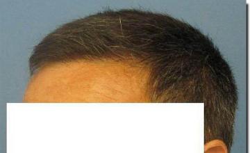 Hair restoration procedure results